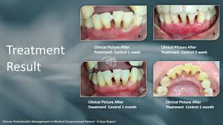 Chronic Periodontitis Management In Medical Compromised Patient  A Case Report [upl. by Evslin]