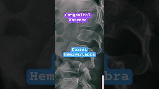 Congenital Hemivertebra spine bones anatomy radiology [upl. by Gallard455]