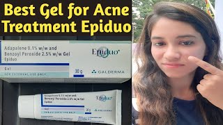 Epiduo Gel for acne amp acne scars  Gel to get rid of pimples  Best cream for acne treatment at home [upl. by Nnep]