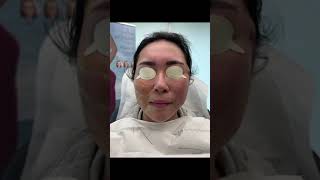 Miracu PDO thread Face Lift Treatment by Dr Tsay  Ageless MD [upl. by Aneladdam]