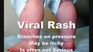 How To Check Meningitis Rash [upl. by Briggs]