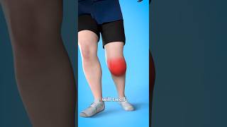 Knee Hyperextension The Surgeries Explained [upl. by Nodmac960]