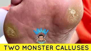 SHAVING OF TWO ENORMOUS MONSTER CALLUSES [upl. by Oluas236]