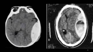 Epidural Hematoma [upl. by Venn471]