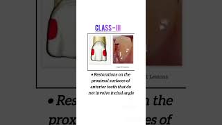 G V Blacks Classification of Dental Caries [upl. by Bergeman764]