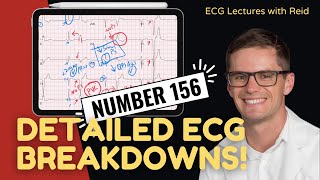 Improve your EKG Skills test yourself  ECG No 156 [upl. by Gingras]