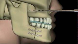 Çift Çene AmeliyatıUpper and Lower Jaw Surgery [upl. by Arytal]