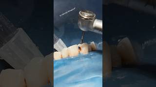 Cavity liner and composite restoration satisfying asmr [upl. by Lienhard70]