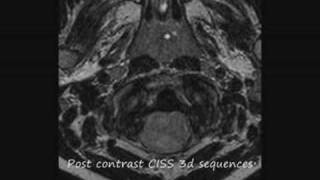 The plastic monster ependymoma how do you deal with this brain tumor in a six year old child [upl. by Icats]