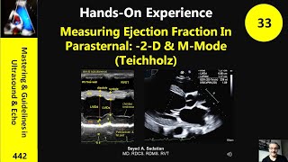 Measuring Ejection Fraction In Parasternal 2D amp MMode Teichholz [upl. by Meagher]