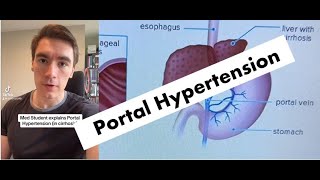 COMPLICATIONS of Portal Hypertension EXPLAINED [upl. by Liarret211]