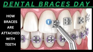 DENTAL BRACES PLACEMENT  HOW DENTAL BRACKET AND WIRES ARE PLACED FOR ORTHODONTIC TREATMENT [upl. by Grimes825]