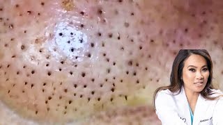 Nose full of blackheads  nose blackheads extraction [upl. by Dlaregztif]