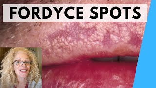 SYRINGOMA VS FORDYCE SPOTS  NATURAL REMEDIES [upl. by Wynn]