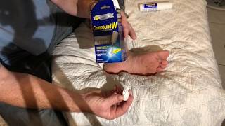 How to remove a plantar wart at home Compound W freeze off wart removal system used on my foot [upl. by Akimak]