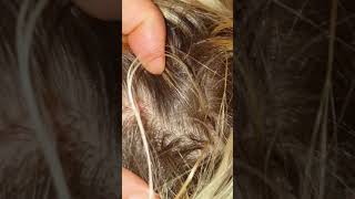 1 good scalp scab picking scratching with fingernails dandruff on my sister ASMR hair little talking [upl. by Brosine532]