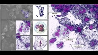 Paptest results with 3D microscope [upl. by Ayaros331]