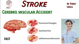 Stroke Nursing CVA Cerebro Vascular Accident in Hindi Ischemic Hemorrhagic symptoms treat tPA [upl. by Evadnee]