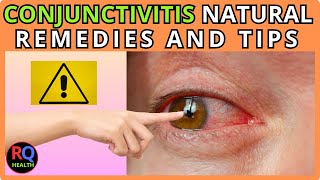 049  quotConjunctivitis Causes Symptoms and Natural Remedies to Cure Itquot [upl. by Htnicayh719]