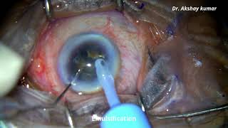 Diabetic cataract nigra with poor cornea  Topical Phacoemulsification [upl. by Oetsira413]