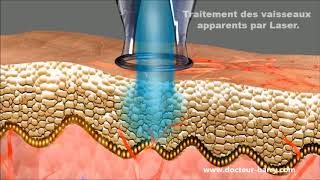 Le traitement de la couperose au laser  Dr Barry [upl. by Ayr126]