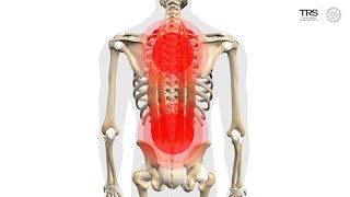 Erector Spinae Trigger Points [upl. by Esilahs]