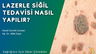 Lazerle Siğil Tedavisi Nasıl Yapılır  Op Dr Atilla KAYA  IDEA Klinik [upl. by Etnovaj]