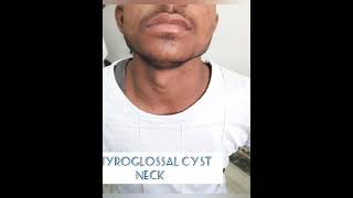 Thyroglossal cyst necksistrunk surgery1432021 [upl. by Aredna59]