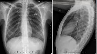 pneumomediastinum [upl. by Henrietta]