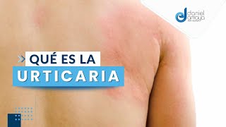 La Urticaria I Alergólogo en Medellín I Alergias en la piel [upl. by Auhel]