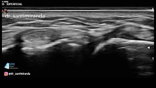 post traumatic gross instability of distal radioulnar joint [upl. by Cy]