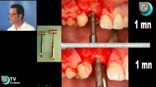 Implants Dentaires  Lexpansion osseuse par le Dr Thierry BRINCAT  GI TV [upl. by Kandy223]