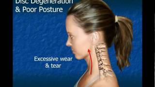 Cervical Disc Degeneration [upl. by Steady]