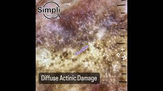 Diffuse Actinic Damage [upl. by Tahpos]