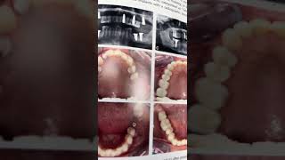 STUDY OF THE MONTH  March 2024 sds youtubeshorts dentalimplants [upl. by Arymat]