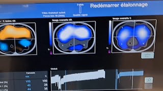 Electrical Impedance Tomography Dorsal Atelectasis corrected with APRV  Proning [upl. by Greenstein]