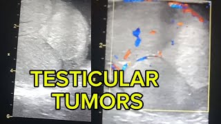 multiple testicular tumors [upl. by Mauceri259]