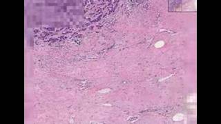 Histopathology Breast Ductal carcinoma [upl. by Saire]