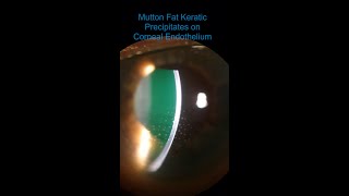 Intermediate Uveitis  Vitritis amp Mutton Fat KPs [upl. by Hesther820]