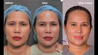 Fox eye thread lift  under eye Derma threads  and skin glow with Eladerm and skin boosters [upl. by Arel]