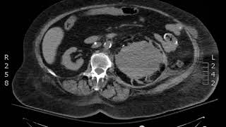 Subcapsular Hematoma CT Axial JETem 2018 [upl. by Ennaisoj608]