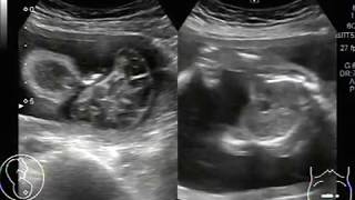 Ultrasound Video showing anencephaly with polyhydramnios [upl. by Alik]