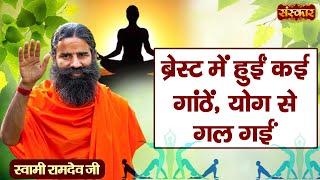 ब्रेस्ट में हुईं कई गाठें योग से गल गईं  Lumps Treatment  Yoga and Ayurveda  Swami Ramdev Ji [upl. by Ylellan510]