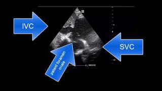 Critical care US for Seniors amazing bicaval view of patent foramen ovale by TTE [upl. by Ainoloppa]