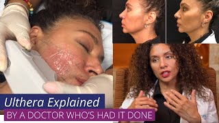 Ulthera aka Ultherapy  Explained by a Doctor whos had Ulthera herself [upl. by Eiblehs843]