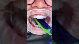 Dentist uses film to test tooth bite Note the bluefullingDIYdentist badbreath 🦷beadrepair [upl. by Katharyn569]