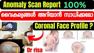 Anomaly Scan Malayalam5th Month Scan In Pregnancy [upl. by Neurath]