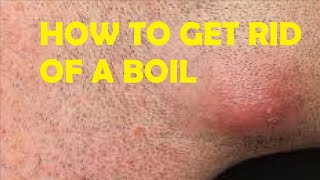 how to get rid of a boil under your armpit fast and easy [upl. by Uaeb676]