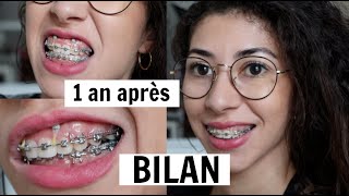 1an après  APPAREIL DENTAIRE DOULEURSVERTIGES  😱 mon expérience [upl. by Brigitta945]