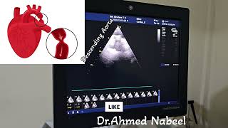 coarctation of Aorta 20 yrs old male missed and treated as a case of HTN 😱🙄 echocardiogram cardio [upl. by Yrrem785]